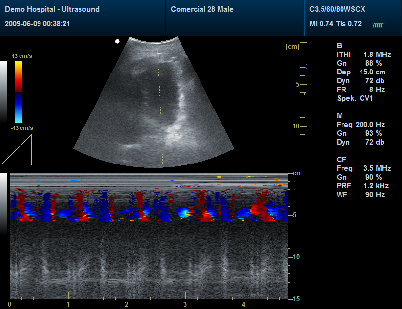 Ecógrafo Cardiológico, Ecógrafo doppler color