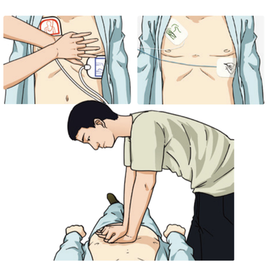 Equipo de reanimación cardiopulmonar - Dea Desfibrilador - Desfibrilador uso profesional