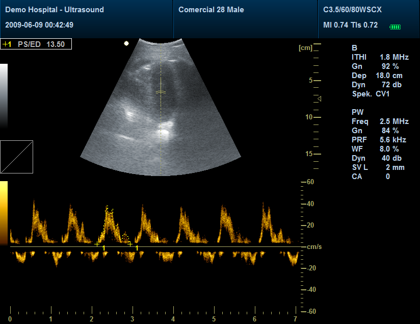 Ecógrafo Cardiológico, Ecógrafo doppler color